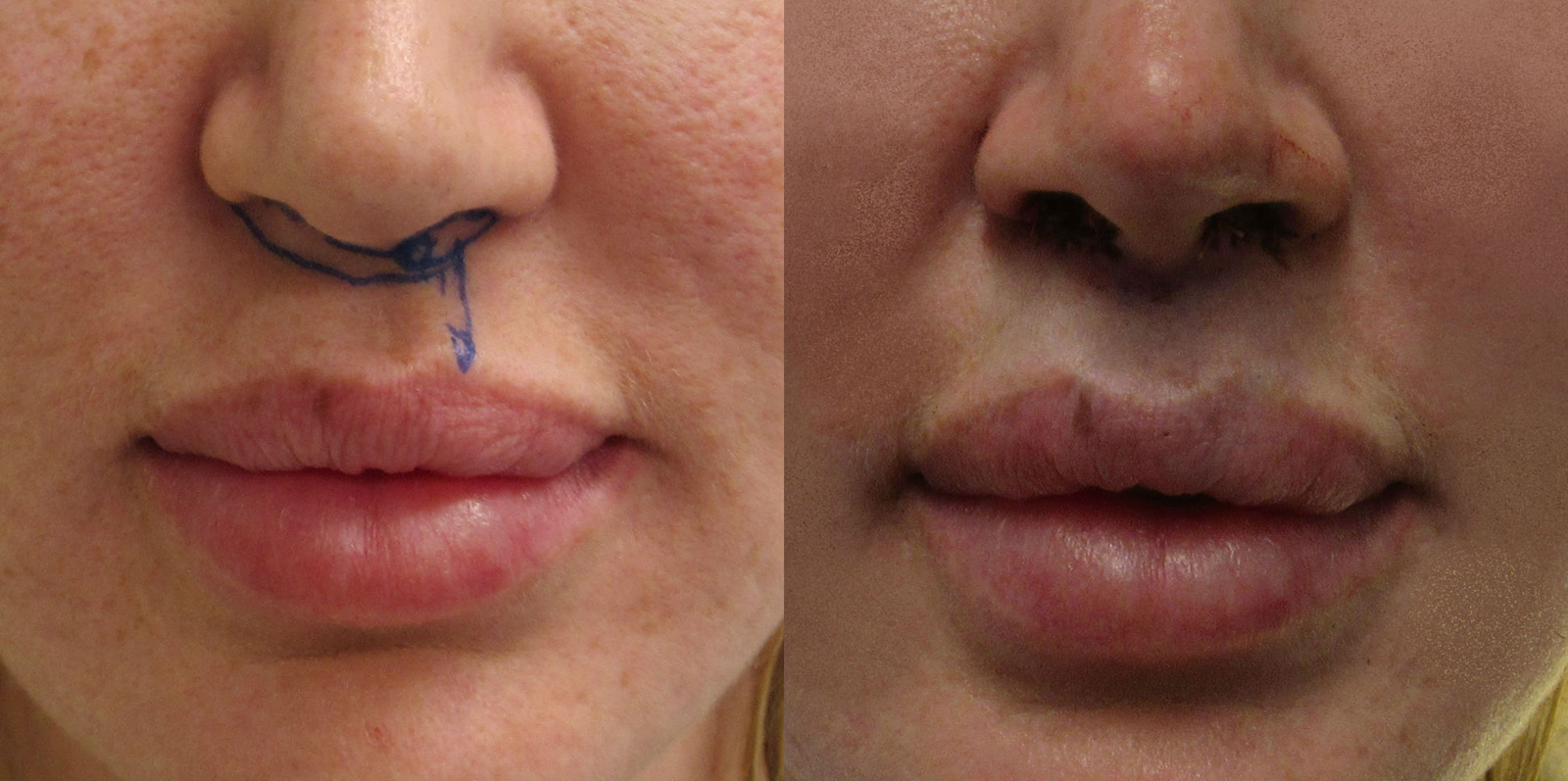 Lip Lift before and after photo by Hughes Plastic Surgery in Los Angeles, CA