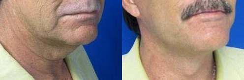 Male Face and Neck Lift before and after photo by Hughes Plastic Surgery in Los Angeles, CA