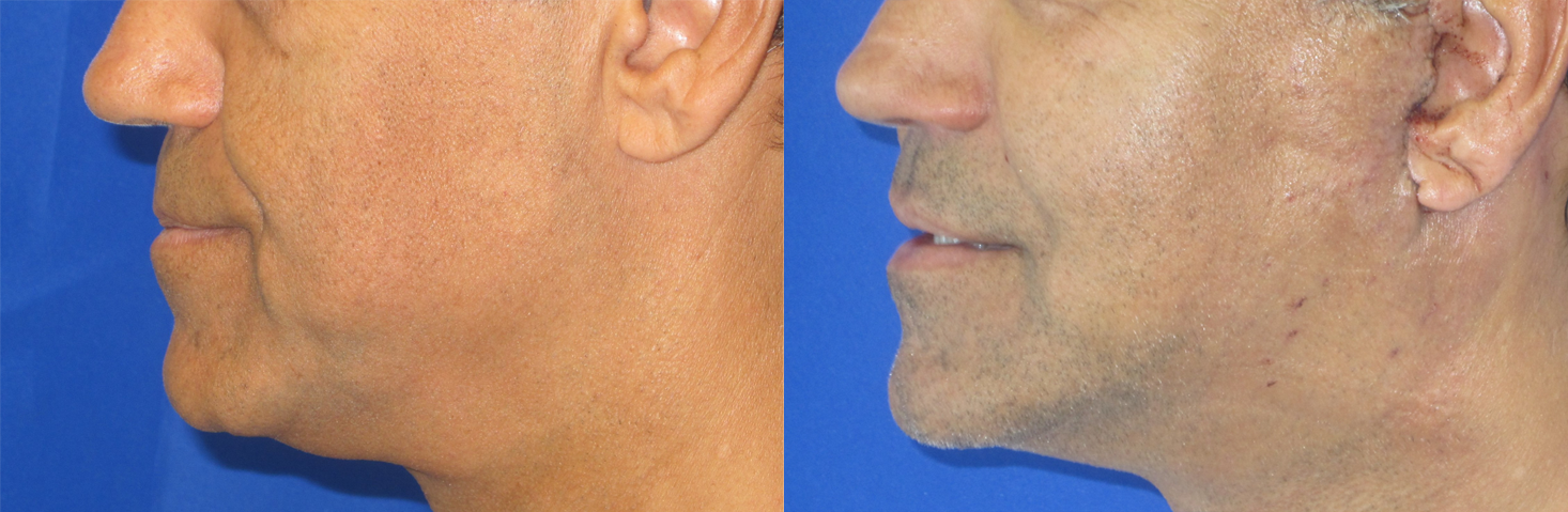 Male Neck Lift before and after photo by Hughes Plastic Surgery in Los Angeles, CA