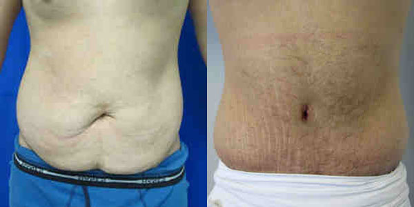 Male Tummy Tuck before and after photo by Hughes Plastic Surgery in Los Angeles, CA