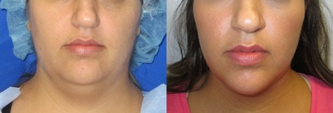 Neck Lift before and after photo by Hughes Plastic Surgery in Los Angeles, CA