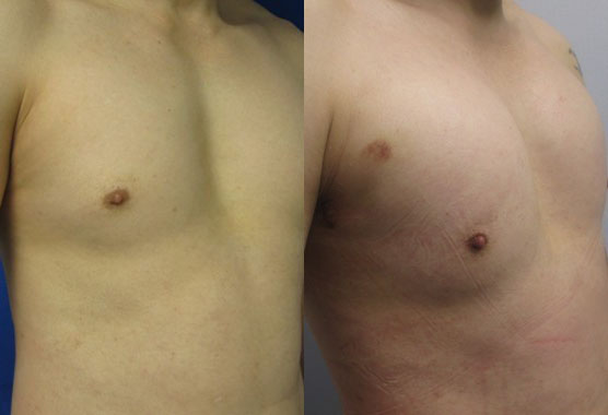 Pec Implants before and after photo by Hughes Plastic Surgery in Los Angeles, CA