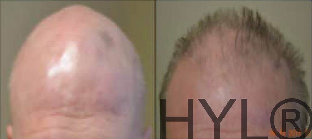 PRP for Hair Loss before and after photo by Hughes Plastic Surgery in Los Angeles, CA