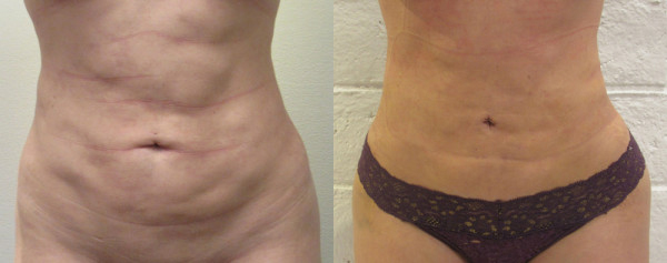 Abdomen before and after photo by Hughes Plastic Surgery in Los Angeles, CA