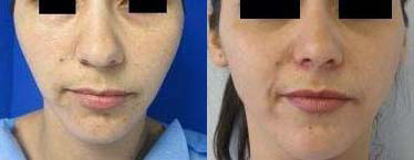 Rhinoplasty before and after photo by Hughes Plastic Surgery in Los Angeles, CA