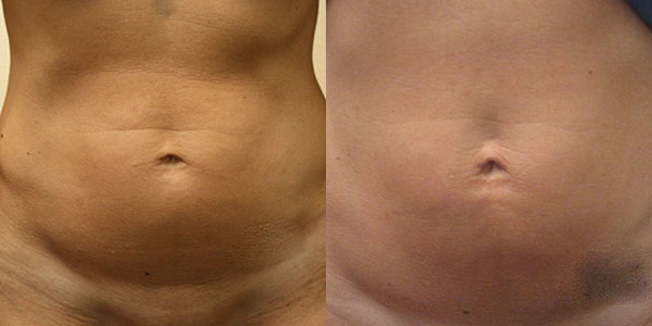 Abdomen before and after photo by Hughes Plastic Surgery in Los Angeles, CA