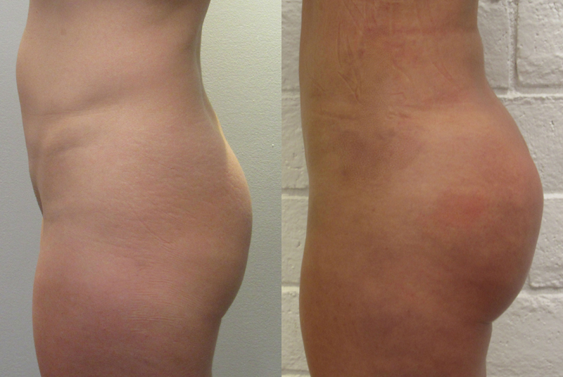 Brazilian Butt Lift for Thinner Patients before and after photo by Hughes Plastic Surgery in Los Angeles, CA