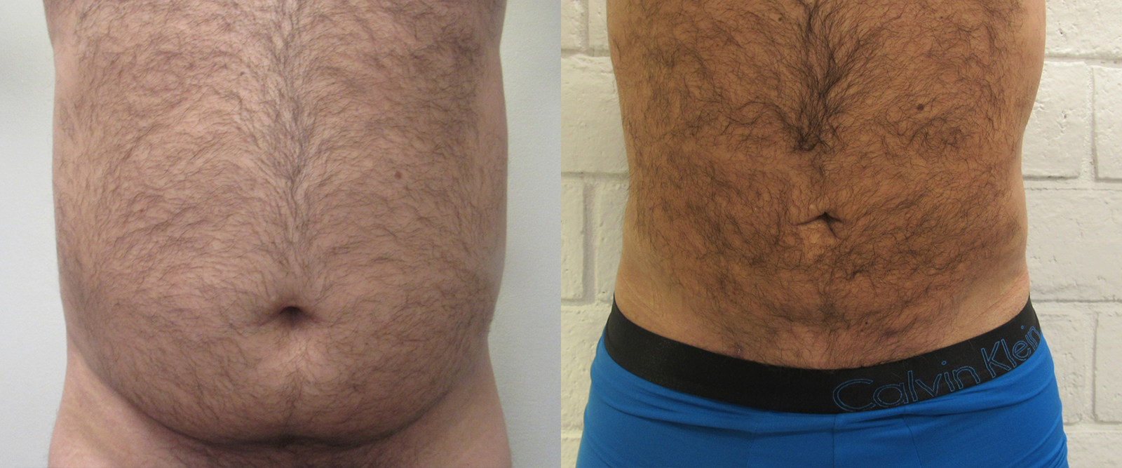 Male Liposuction before and after photo by Hughes Plastic Surgery in Los Angeles, CA