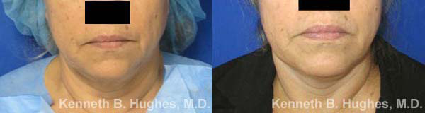 Neck Lift before and after photo by Hughes Plastic Surgery in Los Angeles, CA