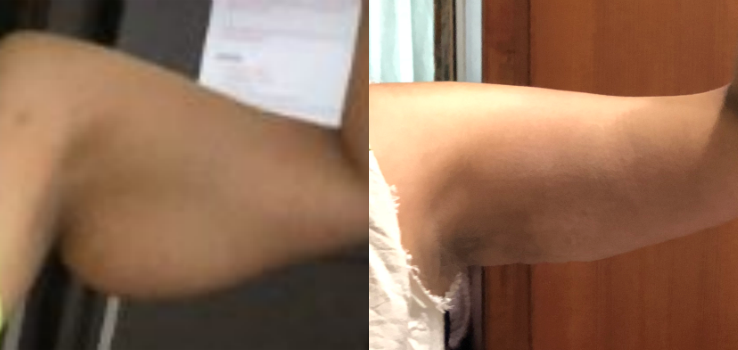 BodyTite before and after photo by Hughes Plastic Surgery in Los Angeles, CA