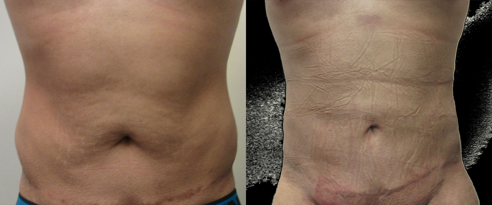 Abdomen before and after photo by Hughes Plastic Surgery in Los Angeles, CA