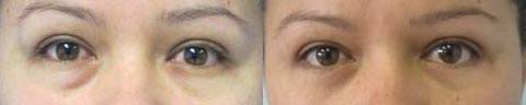Eyelid Surgery before and after photo by Hughes Plastic Surgery in Los Angeles, CA