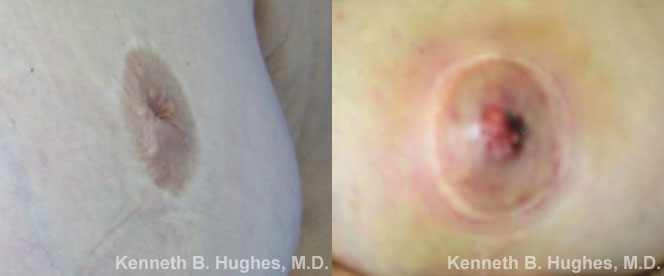 Inverted Nipple Correction before and after photo by Hughes Plastic Surgery in Los Angeles, CA