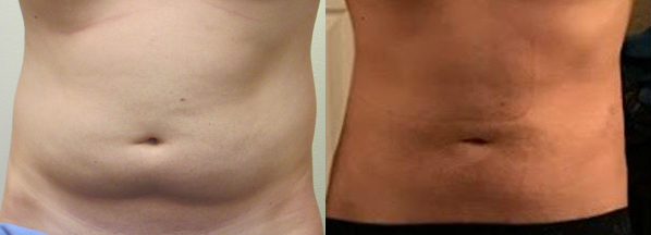 Abdomen before and after photo by Hughes Plastic Surgery in Los Angeles, CA