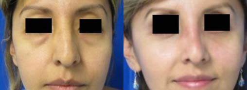 Eyelid Surgery before and after photo by Hughes Plastic Surgery in Los Angeles, CA