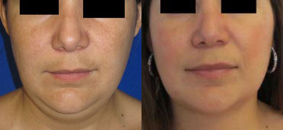 Chin Liposuction before and after photo by Hughes Plastic Surgery in Los Angeles, CA