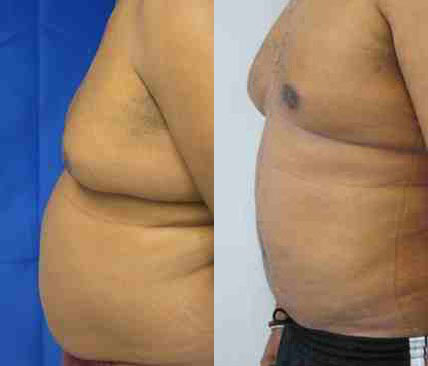 Male Liposuction before and after photo by Hughes Plastic Surgery in Los Angeles, CA
