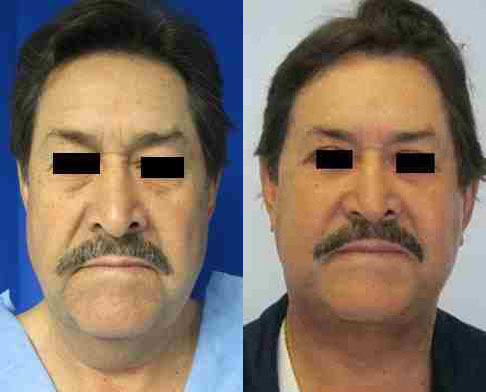 Male Neck Lift before and after photo by Hughes Plastic Surgery in Los Angeles, CA