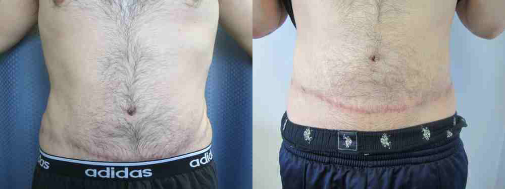 Male Tummy Tuck before and after photo by Hughes Plastic Surgery in Los Angeles, CA