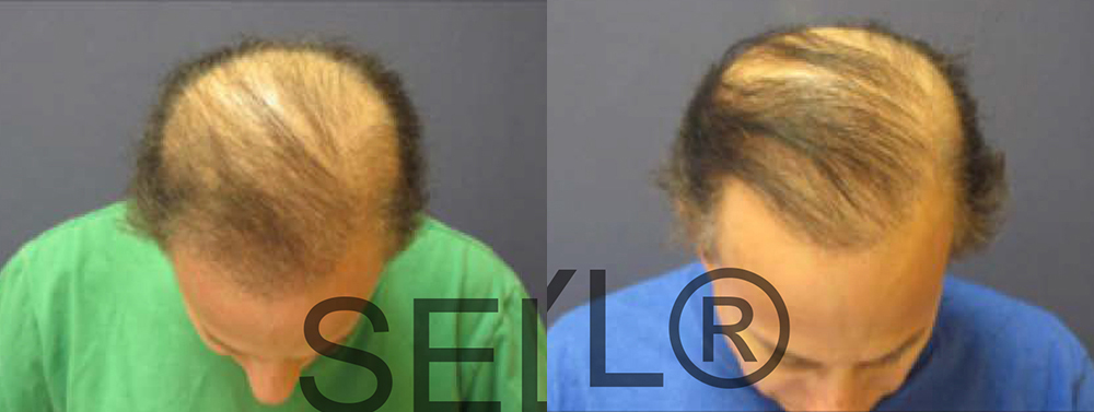 PRP for Hair Loss before and after photo by Hughes Plastic Surgery in Los Angeles, CA
