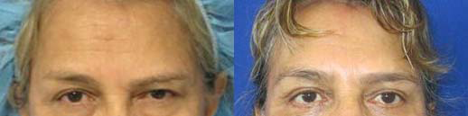Eyelid Surgery before and after photo by Hughes Plastic Surgery in Los Angeles, CA