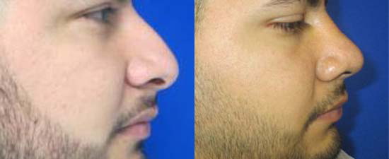 Rhinoplasty before and after photo by Hughes Plastic Surgery in Los Angeles, CA