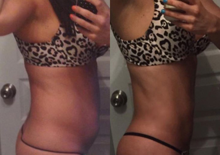 Brazilian Butt Lift for Thinner Patients before and after photo by Hughes Plastic Surgery in Los Angeles, CA