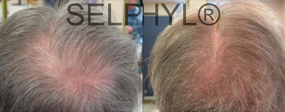 PRP for Hair Loss before and after photo by Hughes Plastic Surgery in Los Angeles, CA