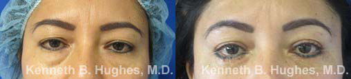 Eyelid Surgery before and after photo by Hughes Plastic Surgery in Los Angeles, CA