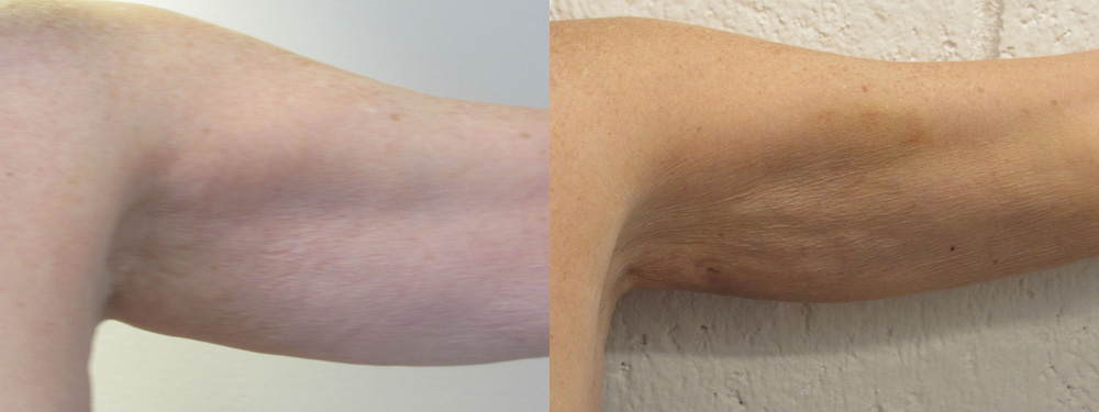 BodyTite before and after photo by Hughes Plastic Surgery in Los Angeles, CA