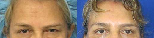 Brow Lift before and after photo by Hughes Plastic Surgery in Los Angeles, CA