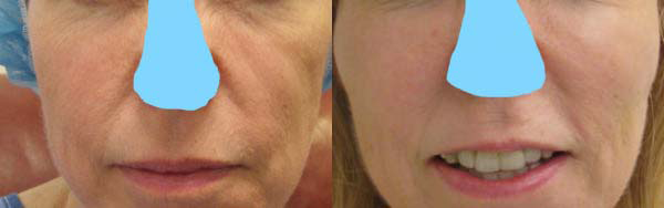 Facelift before and after photo by Hughes Plastic Surgery in Los Angeles, CA