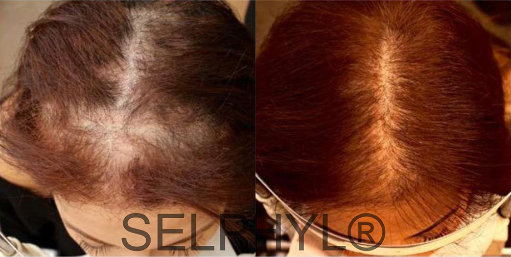 PRP for Hair Loss before and after photo by Hughes Plastic Surgery in Los Angeles, CA