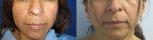 Rhinoplasty before and after photo by Hughes Plastic Surgery in Los Angeles, CA