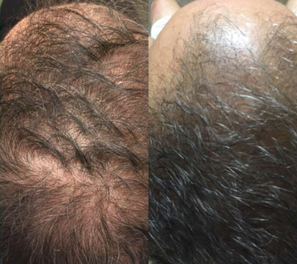 PRP for Hair Loss before and after photo by Hughes Plastic Surgery in Los Angeles, CA