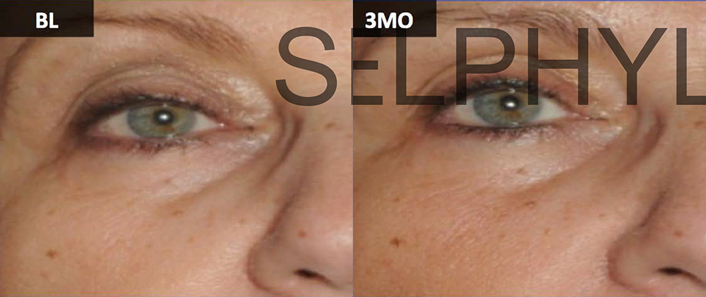 PRP for facial Rejuvenation before and after photo by Hughes Plastic Surgery in Los Angeles, CA