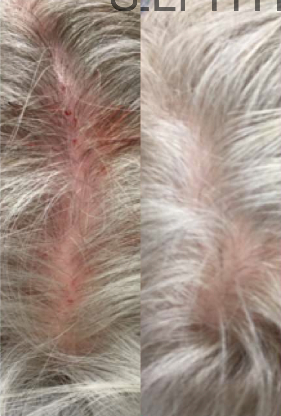 PRP for Hair Loss before and after photo by Hughes Plastic Surgery in Los Angeles, CA