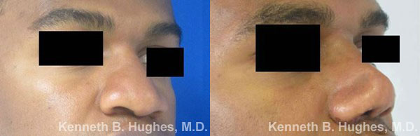 Rhinoplasty before and after photo by Hughes Plastic Surgery in Los Angeles, CA