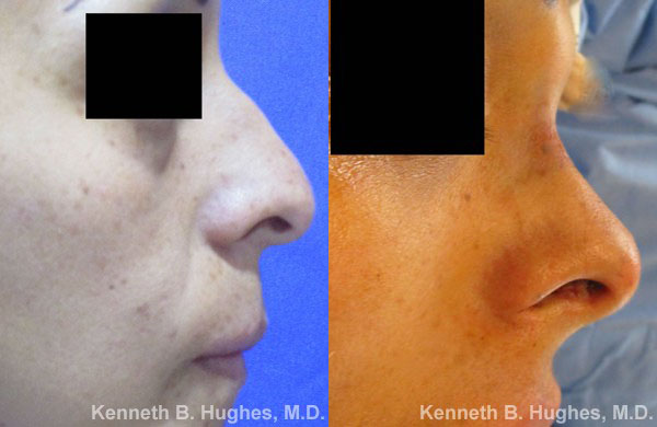 Rhinoplasty before and after photo by Hughes Plastic Surgery in Los Angeles, CA