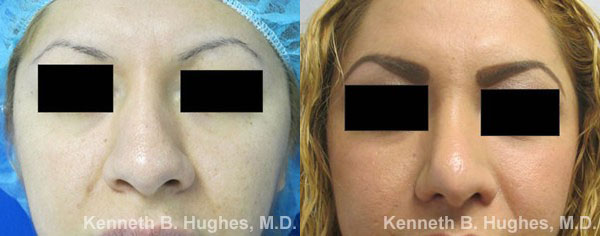 Rhinoplasty before and after photo by Hughes Plastic Surgery in Los Angeles, CA