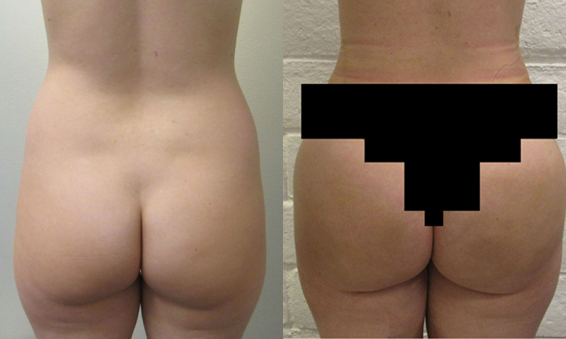 Brazilian Butt Lift for Thinner Patients before and after photo by Hughes Plastic Surgery in Los Angeles, CA