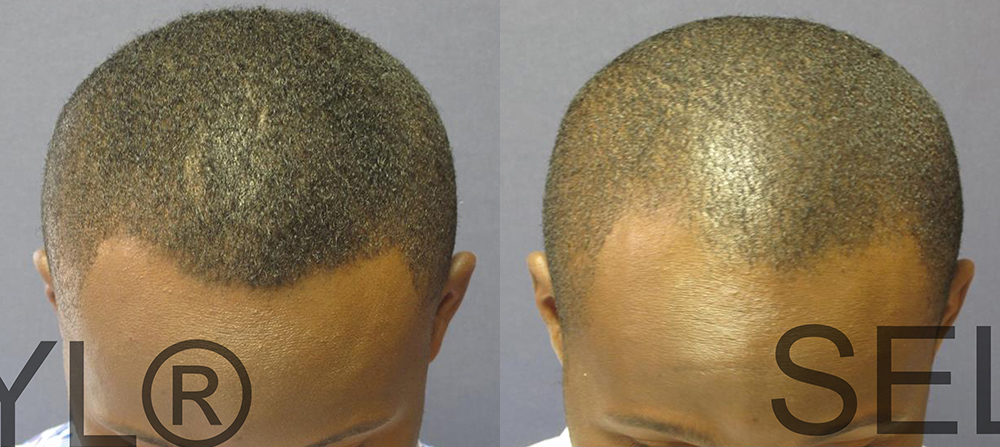PRP for Hair Loss before and after photo by Hughes Plastic Surgery in Los Angeles, CA