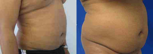 Male Liposuction before and after photo by Hughes Plastic Surgery in Los Angeles, CA