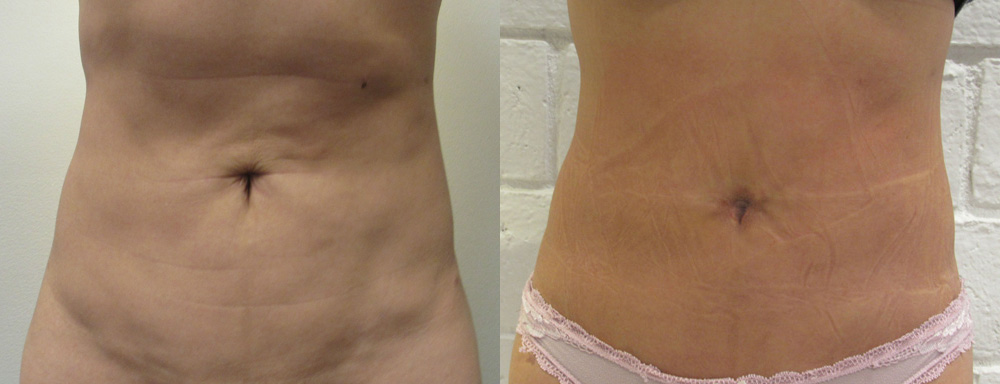 Abdomen before and after photo by Hughes Plastic Surgery in Los Angeles, CA