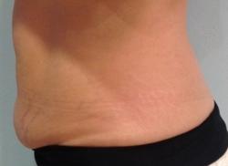 BodyFX Before & After Patient #11658