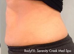 BodyFX Before & After Patient #11658