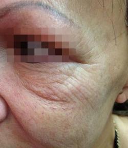 Fractora Before & After Patient #11694
