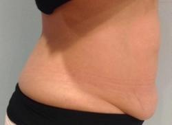BodyFX Before & After Patient #11658