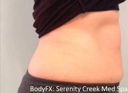 BodyFX Before & After Patient #11658