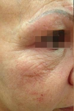 Fractora Before & After Patient #11694